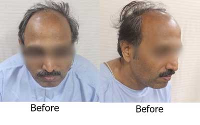 Hair Transplant Before