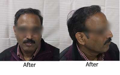 Hair Transplant After